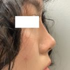 An After Photo of Non-Surgical Rhinoplasty in Bellevue and Kirkland