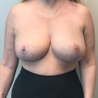 An After Photo of a Breast Reduction with Lift Plastic Surgery by Dr. Craig Jonov in Bellevue and Kirkland