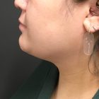 An After Photo of Chin Liposuction Plastic Surgery by Dr. Craig Jonov in Bellevue and Kirkland