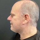 An After Photo of a Lower Male Facelift Plastic Surgery in Bellevue and Kirkland
