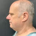 A Before Photo of a Lower Male Facelift Plastic Surgery in Bellevue and Kirkland