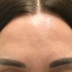 An After Photo of Botox Injections in Bellevue and Kirkland