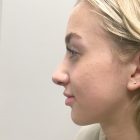 An After Photo of a Rhinoplasty Plastic Surgery by Dr. Craig Jonov in Bellevue and Kirkland