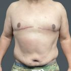 An After Photo of Gynecomastia Plastic Surgery by Dr. Craig Jonov in Bellevue and Kirkland