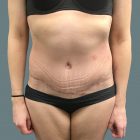 An After Photo of a Tummy Tuck Plastic Surgery by Dr. Craig Jonov in Bellevue and Kirkland