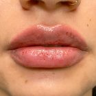 An After Photo of Restylane Kysse Lip Filler in Bellevue and Kirkland