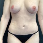 An After Photo of a Mini Tummy Tuck Plastic Surgery by Dr. Craig Jonov in Bellevue and Kirkland
