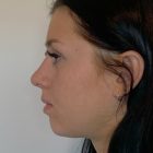 An After Photo of a Rhinoplasty Plastic Surgery by Dr. Craig Jonov in Bellevue and Kirkland