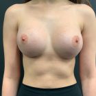 An After Photo of a Breast Augmentation Plastic Surgery by Dr. Craig Jonov in Bellevue and Kirkland