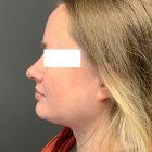 An After Photo of Chin Liposuction Plastic Surgery by Dr. Craig Jonov in Bellevue and Kirkland