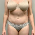 An After Photo of a Tummy Tuck Plastic Surgery by Dr. Craig Jonov in Bellevue and Kirkland