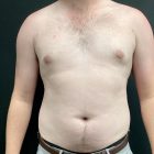 An After Photo of Gynecomastia Plastic Surgery by Dr. Craig Jonov in Bellevue and Kirkland