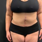 An After Photo of a Fleur-de-lis Tummy Tuck Plastic Surgery by Dr. Craig Jonov in Bellevue and Kirkland