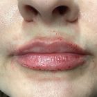 An After Photo of Restylane Kysse Lip Filler in Bellevue and Kirkland