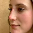 An After Photo of a Non-Surgical Rhinoplasty in Bellevue and Kirkland