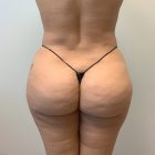 An After Photo of a Brazilian Butt Lift Plastic Surgery by Dr. Craig Jonov in Bellevue and Kirkland