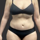 An After Photo of an Extended Tummy Tuck Plastic Surgery by Dr. Craig Jonov in Bellevue and Kirkland
