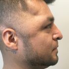 An After Photo of a Male Rhinoplasty Plastic by Dr. Craig Jonov in Bellevue and Kirkland