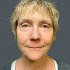 An After Photo of a Brow Lift Plastic Surgery by Dr. Craig Jonov in Bellevue and Kirkland