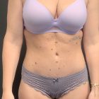 An After Photo of a Tummy Tuck Plastic Surgery by Dr. Craig Jonov in Bellevue and Kirkland