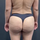 An After Photo of a Brazilian Butt Lift Plastic Surgery by Dr. Craig Jonov in Bellevue and Kirkland