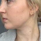 An After Photo of Facial Liposuction Plastic Surgery by Dr. Craig Jonov in Bellevue and Kirkland