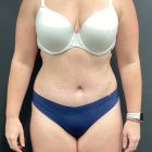 An After Photo of a Tummy Tuck Plastic Surgery by Dr. Craig Jonov in Bellevue and Kirkland