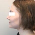 An After Photo of A Chin Liposuction Plastic Surgery by Dr. Craig Jonov in Bellevue and Kirkland