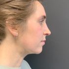 An After Photo of Chin Liposuction Plastic Surgery by Dr. Craig Jonov in Bellevue and Kirkland
