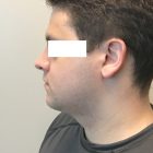 An After Photo of Chin Liposuction Plastic Surgery by Dr. Craig Jonov in Bellevue and Kirkland
