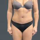 An After Photo of a Tummy Tuck Plastic Surgery by Dr. Craig Jonov in Bellevue and Kirkland