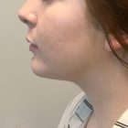 An After Photo of Chin Liposuction Plastic Surgery by Dr. Craig Jonov in Bellevue and Kirkland