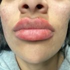 An After Photo of Cheek Filler Injections in Bellevue and Kirkland