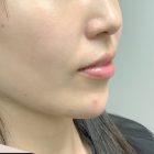 An After Photo of Cheek Filler In Bellevue and Kirkland