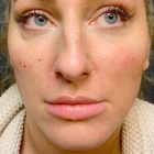 An After Photo of Cheek Filler Injections in Bellevue and Kirkland