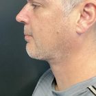 An After Photo of Chin Liposuction & Chin Augmentation Plastic Surgery by Dr. Craig Jonov in Bellevue and Kirkland