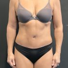An After Photo of a Tummy Tuck Plastic Surgery by Dr. Craig Jonov in Bellevue and Kirkland