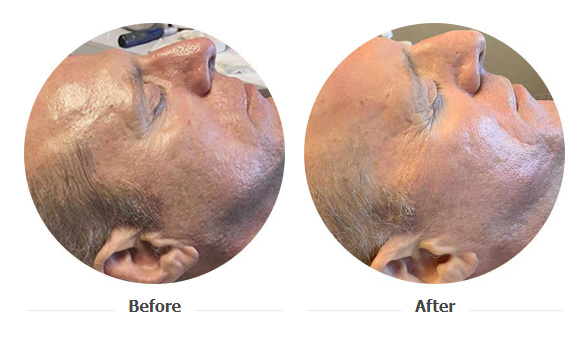 rf-microneedling-01 rf-microneedling-01