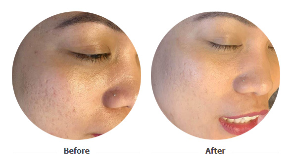 rf-microneedling-02 rf-microneedling-02