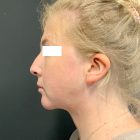 An After Photo of Chin Liposuction Plastic Surgery by Dr. Craig Jonov in Bellevue and Kirkland