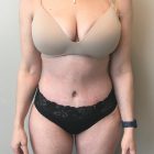 An After Photo of a Tummy Tuck Plastic Surgery in Bellevue and Kirkland by top plastic surgeon Dr. Craig Jonov