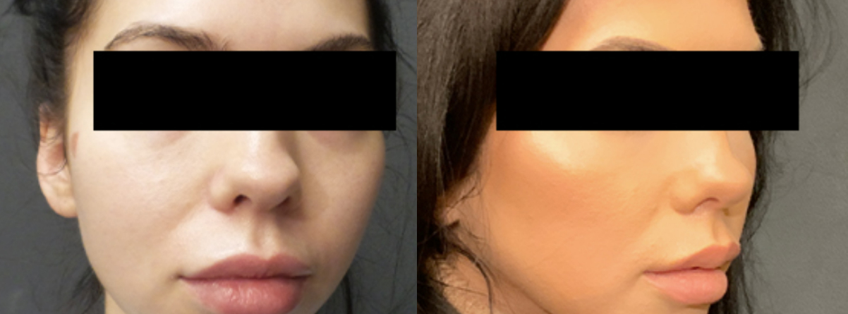 Buccal-Fat-Removal-before-after-02