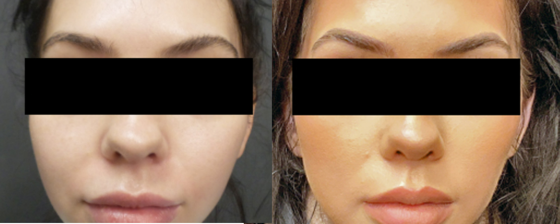 Buccal-Fat-Removal-before-after