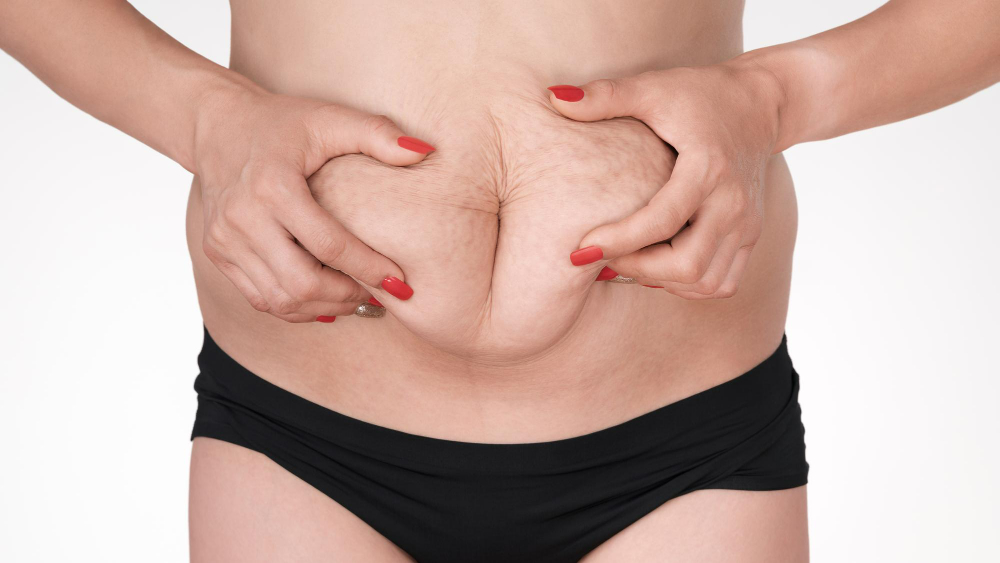How Can a Tummy Tuck in Kirkland Transform Your Body Shape?