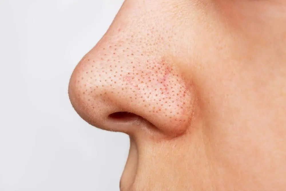 What Skin Problems Can HydraFacial Help With?