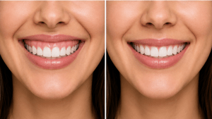 Gummy Smile Botox Before and After