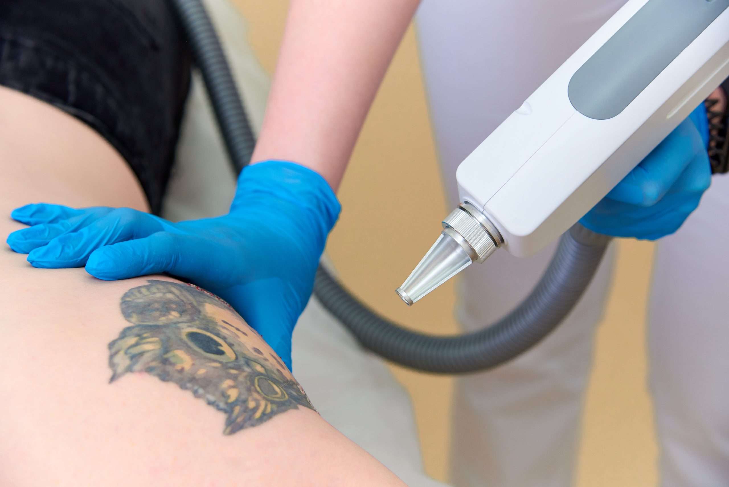 Can All Tattoo Colors Be Safely Removed with Laser Treatments?