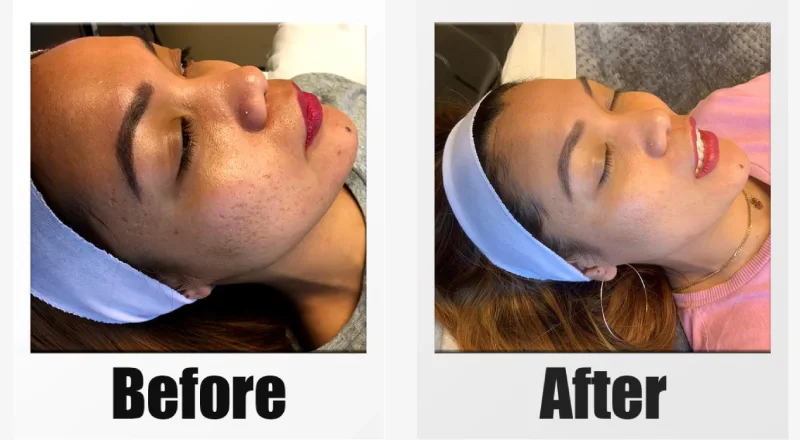 glutathione injection bellingham Microneedling Bellevue, Kirkland & Seattle Wellness Shots London Ontario