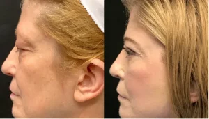 Before and After