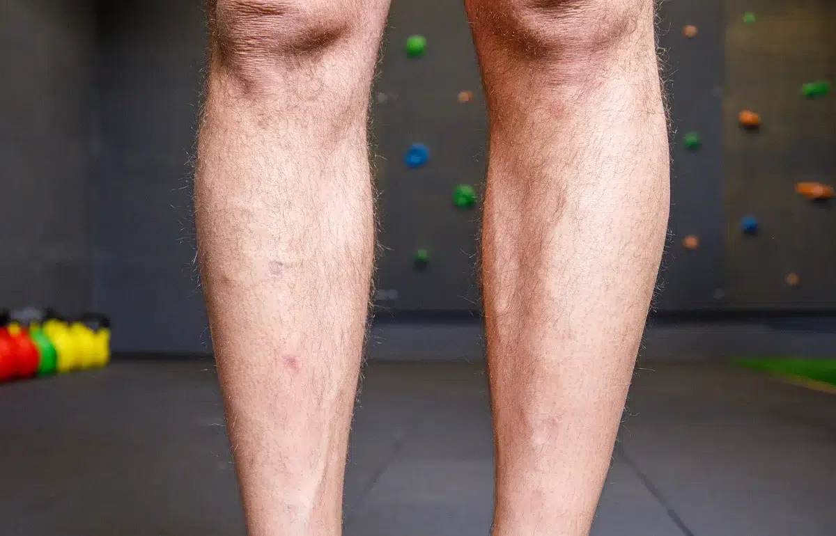 How Does the alloClae® Calf Procedure Work?
